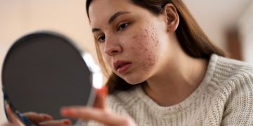 Saat Berjerawat Hindari Makanan Ini!