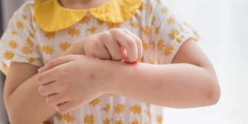 Penyakit Kulit pada Anak yang Rentan Dialami