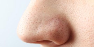 Cara Menghilangkan Komedo di Hidung Secara Alami