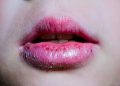 Bibir Pecah-pecah